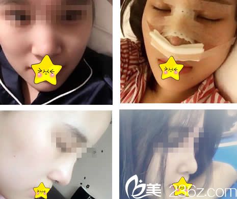 仁和医生鼻综合整形案例