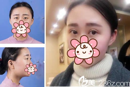 兰州仁和整形王彦平医生全切双眼皮+开眼角三个月效果案例 兰州仁和整形王彦平医生全切双眼皮+开眼角三个月效果案例