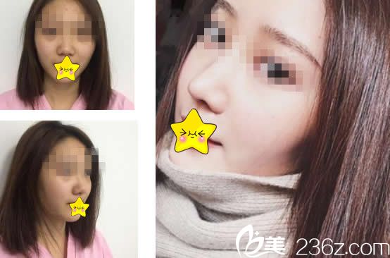 王彦平医生隆鼻效果好吗 王彦平医生隆鼻效果好吗