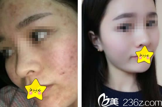 兰州仁和王彦平点阵激光祛痘效果 兰州仁和王彦平点阵激光祛痘效果