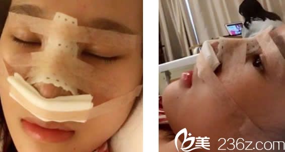 仁和<!--<i data=20240703-sp></i>-->自体肋软骨隆鼻当天