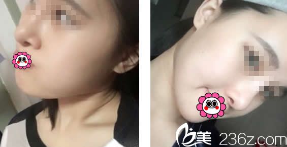 自体软骨隆鼻13天效果