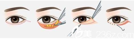 上海第九人民医院整形美容外科内路法祛眼袋