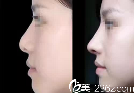 鼻部手术真人案例 鼻部手术真人案例