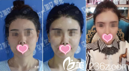 面部脂肪填充前后对比效果 面部脂肪填充前后对比效果