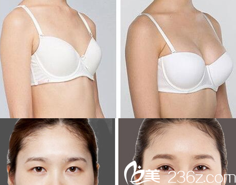 重庆好美假体隆胸、全切无痕双眼皮 重庆好美假体隆胸、全切无痕双眼皮