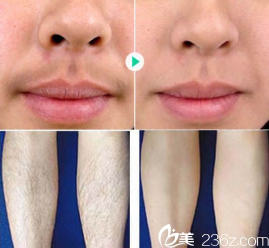 陈秋珍唇部和小腿脱毛案例图