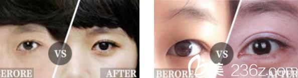 汝森杨子伟双眼皮效果 汝森杨子伟双眼皮效果