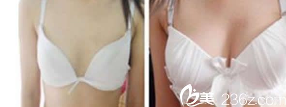 包头汝森自体脂肪丰胸案例 包头汝森自体脂肪丰胸案例