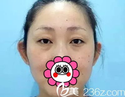 在长春医美做双眼皮整形前 在长春医美做双眼皮整形前