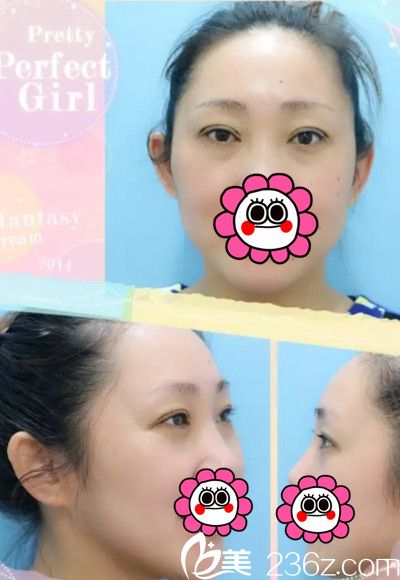 在长春医美做双眼皮整形效果 在长春医美做双眼皮整形效果