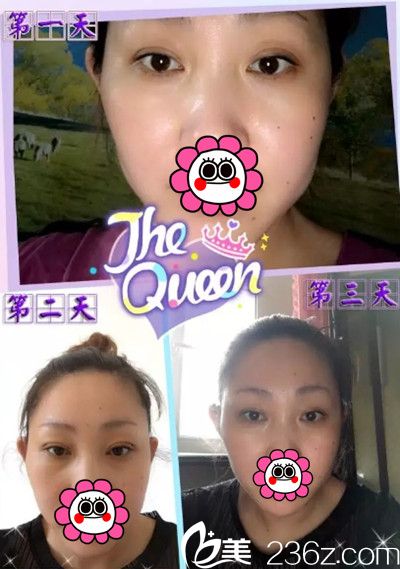 在长春医美做双眼皮整形后1-3天恢复 在长春医美做双眼皮整形后1-3天恢复