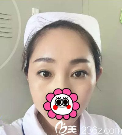 在长春医美做双眼皮整形术后十天 在长春医美做双眼皮整形术后十天