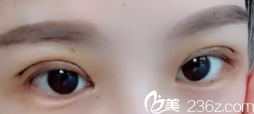 芜湖第二人民医院整形科做双眼失败修复手术后第3天情况