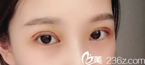 谈谈我找芜湖二院烧伤整形科庄庆元做双眼皮失败修复手术恢复过程和感受