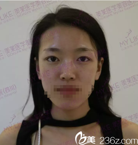 双眼皮术前的娜娜内双、眼睛无神 双眼皮术前的娜娜内双、眼睛无神