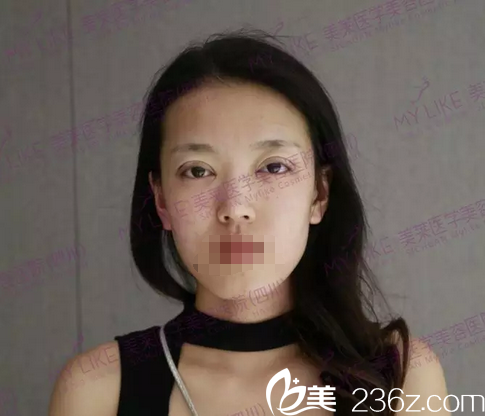 成都美莱梁军切开双眼皮术后即刻 成都美莱梁军切开双眼皮术后即刻