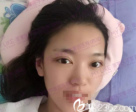 梁军双眼皮术后3天恢复效果 梁军双眼皮术后3天恢复效果