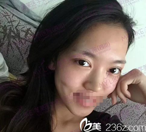 四川美莱梁军双眼皮拆线后效果 四川美莱梁军双眼皮拆线后效果