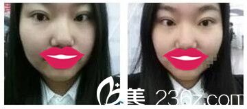 郑州丽天做双眼皮后12天