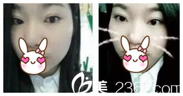 郑州丽天双眼皮后20天