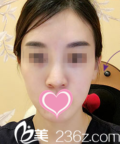 自体脂肪填充面部术前照 自体脂肪填充面部术前照