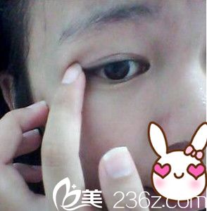贴双眼皮贴