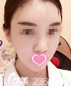 手术后第四天效果 手术后第四天效果