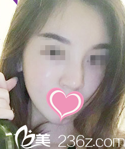 自体脂肪填充面部一周效果 自体脂肪填充面部一周效果