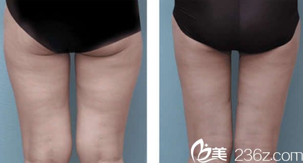 汝森李禹震腿部吸脂案例 汝森李禹震腿部吸脂案例