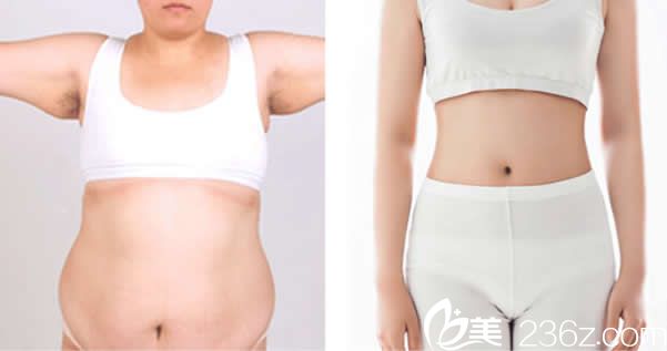 汝森腰腹部吸脂效果 汝森腰腹部吸脂效果