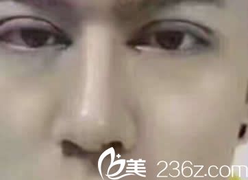 汝森杨子伟双眼皮天