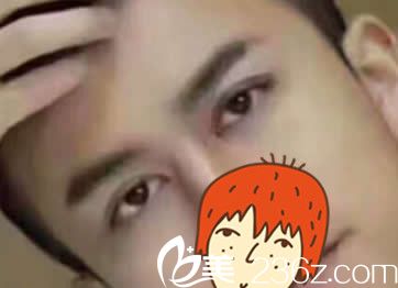 大家觉得我找包头汝森杨子伟做切开法双眼皮一个月后还会为找不到女票发愁吗