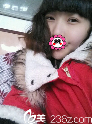 术后20天眼睛慢慢恢复中 术后20天眼睛慢慢恢复中