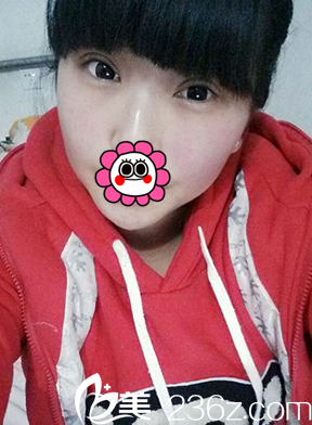 做完双眼皮和开眼角手术15天慢慢消肿 做完双眼皮和开眼角手术15天慢慢消肿