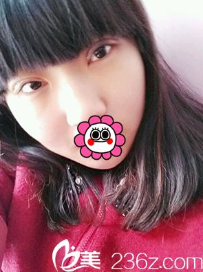 术后7天眼睛拆线后的样子 术后7天眼睛拆线后的样子