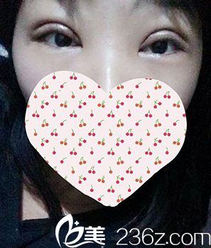 做完双眼皮和开眼角第2天肿胀厉害 做完双眼皮和开眼角第2天肿胀厉害