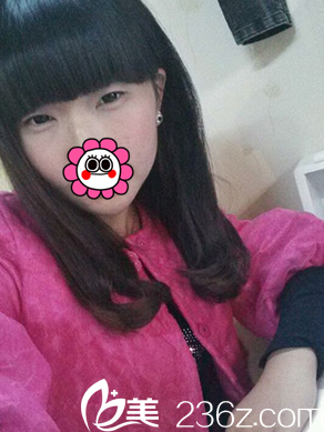 眼综合整形前是单眼皮 眼综合整形前是单眼皮