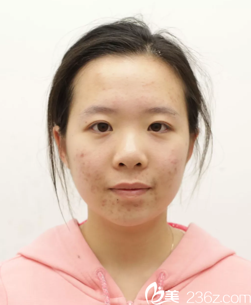 做五官整形手术前的笑笑 做五官整形手术前的笑笑