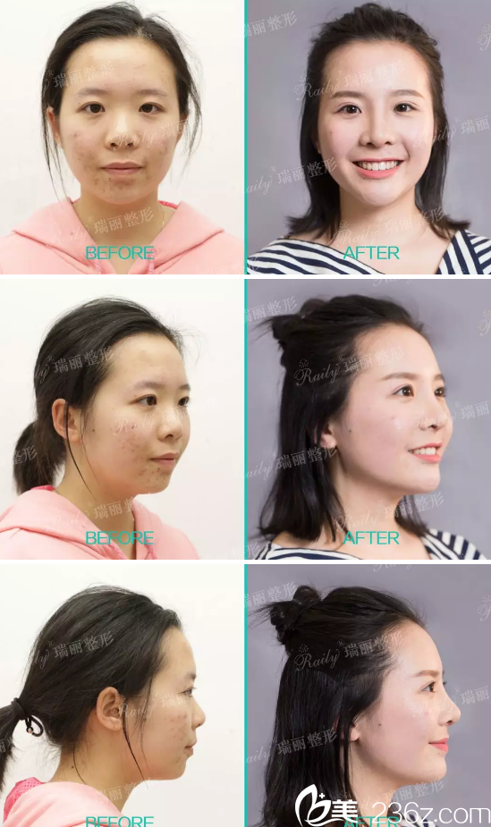 杭州瑞丽宋建良眼鼻综合整形案例 杭州瑞丽宋建良眼鼻综合整形案例