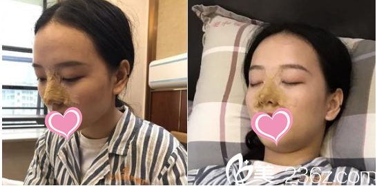 潍坊华美医疗美容医院做的隆鼻手术当天