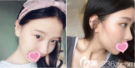 鼻子恢复到一个月的时候