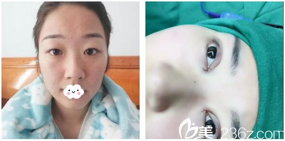 双眼皮术前和术后即刻效果 双眼皮术前和术后即刻效果