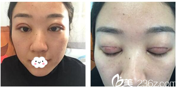 双眼皮术后5天恢复情况 双眼皮术后5天恢复情况