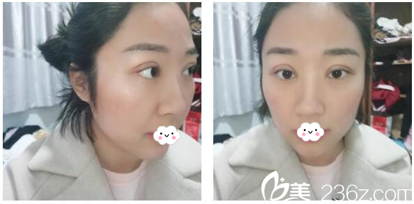 切开双眼皮8天后的自拍 切开双眼皮8天后的自拍