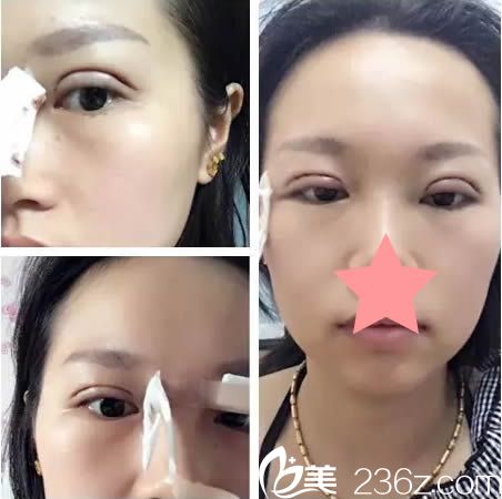 做完全切双眼皮天的照片