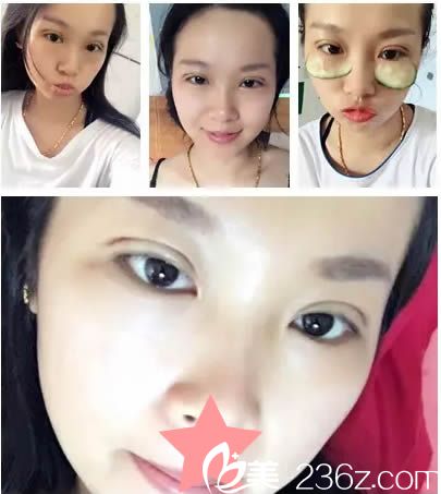 切开双眼皮第5天恢复效果