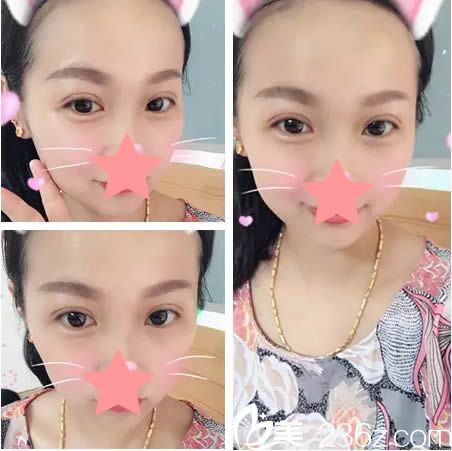 陈运生主任为我做完双眼皮15天后的美照