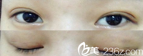 韩式微创双眼皮手术一个星期样子