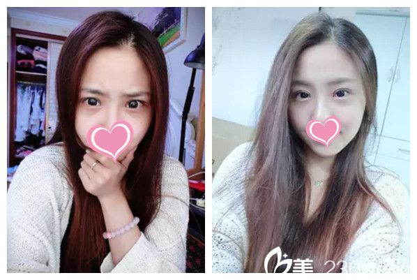 刘运涛主任做双眼皮案例